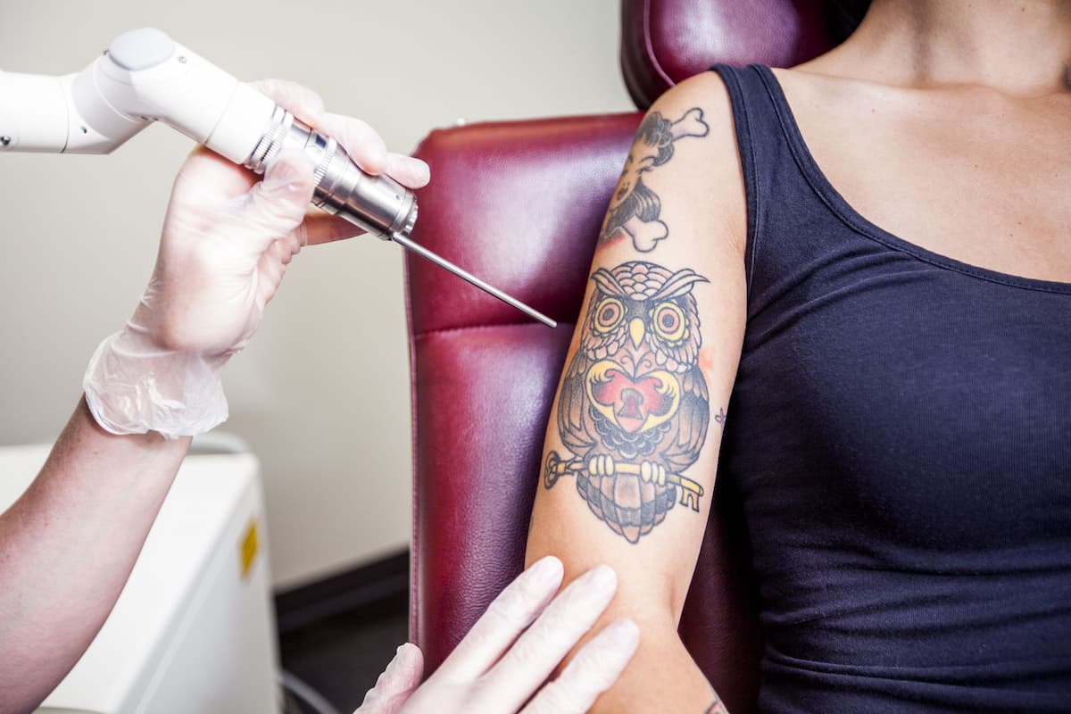Additional Frequently Asked Questions about Laser Tattoo Removal