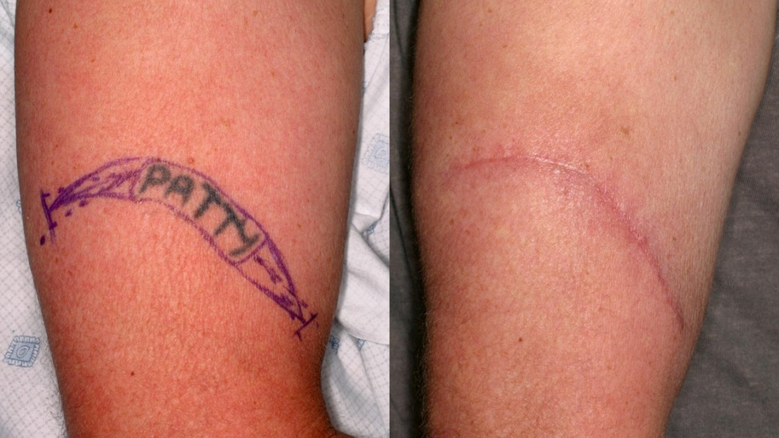 Después de la eliminación quirúrgica de tatuajes con cicatriz