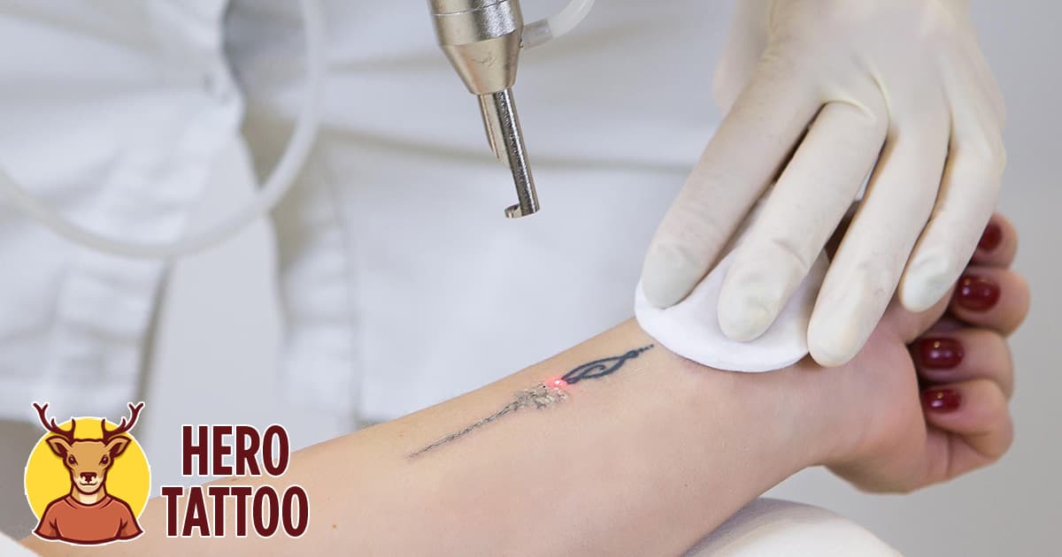Las mejores máquinas de eliminación de tatuajes por láser a la venta