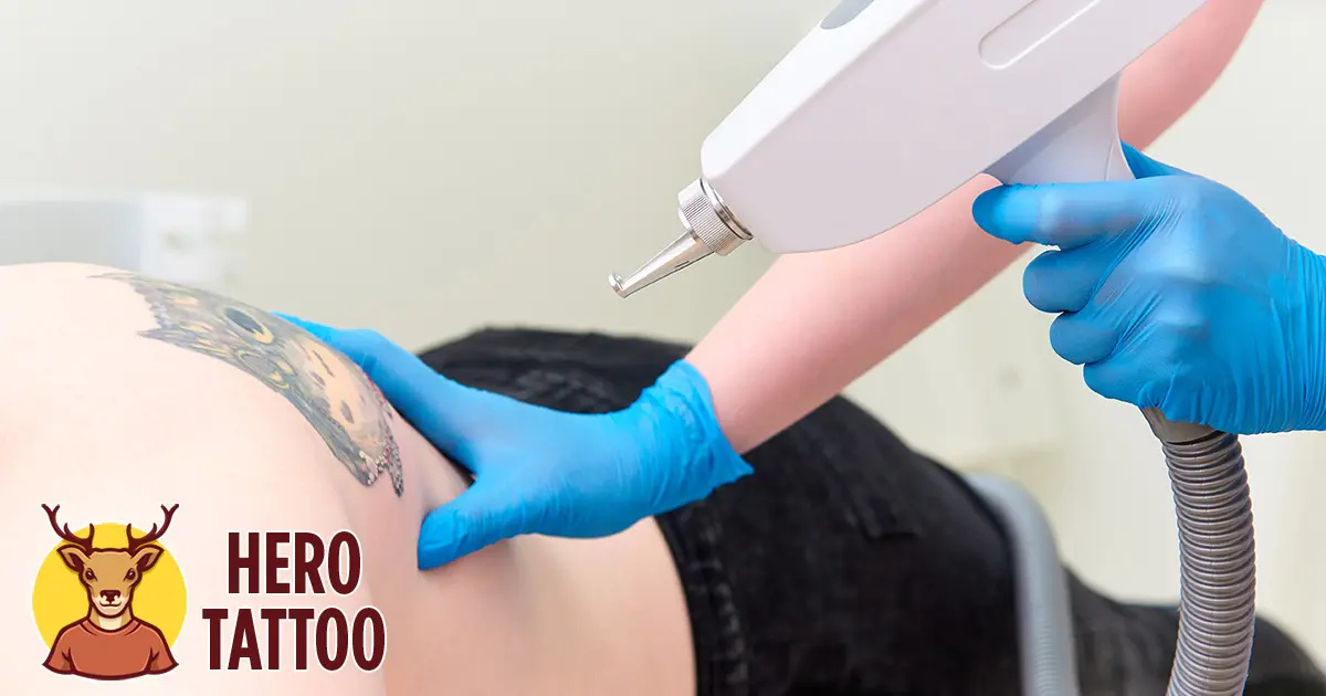 Coste de la eliminación de tatuajes con láser