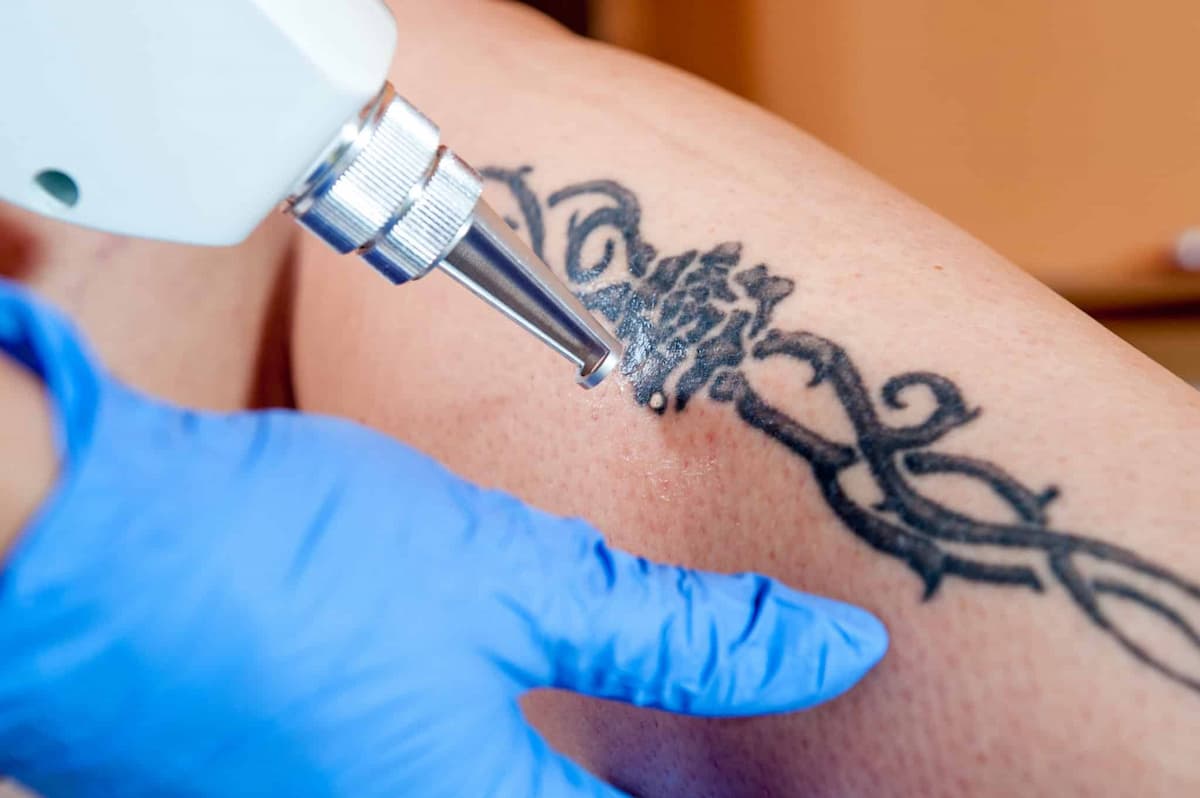 Laser Tattoo Removal hero tattoo 1