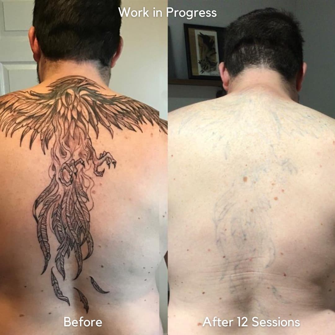Tattoo Removal Why Multiple Sessions Are Needed 1