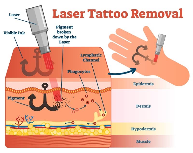Wavelengths pulses and energy of laser tattoo removal