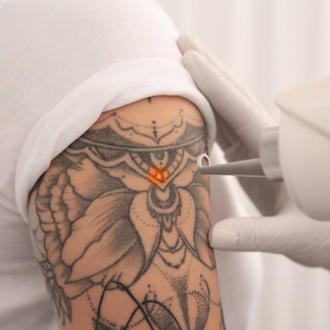 laser tattoo removal 1