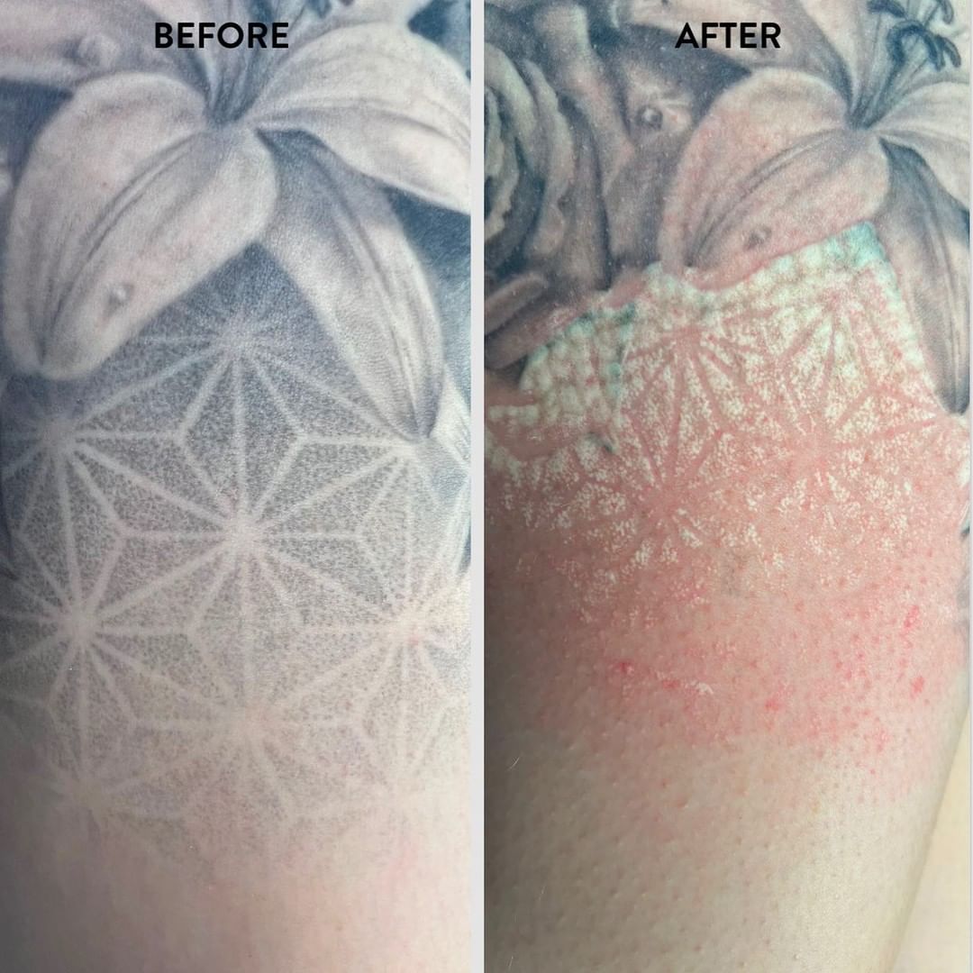 tattoo removal before and after