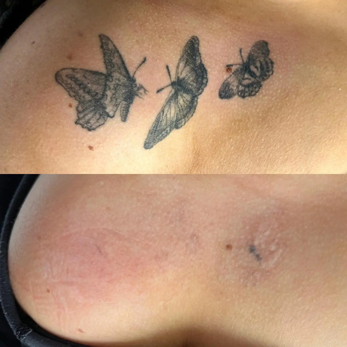 Tattoo Removal Prices